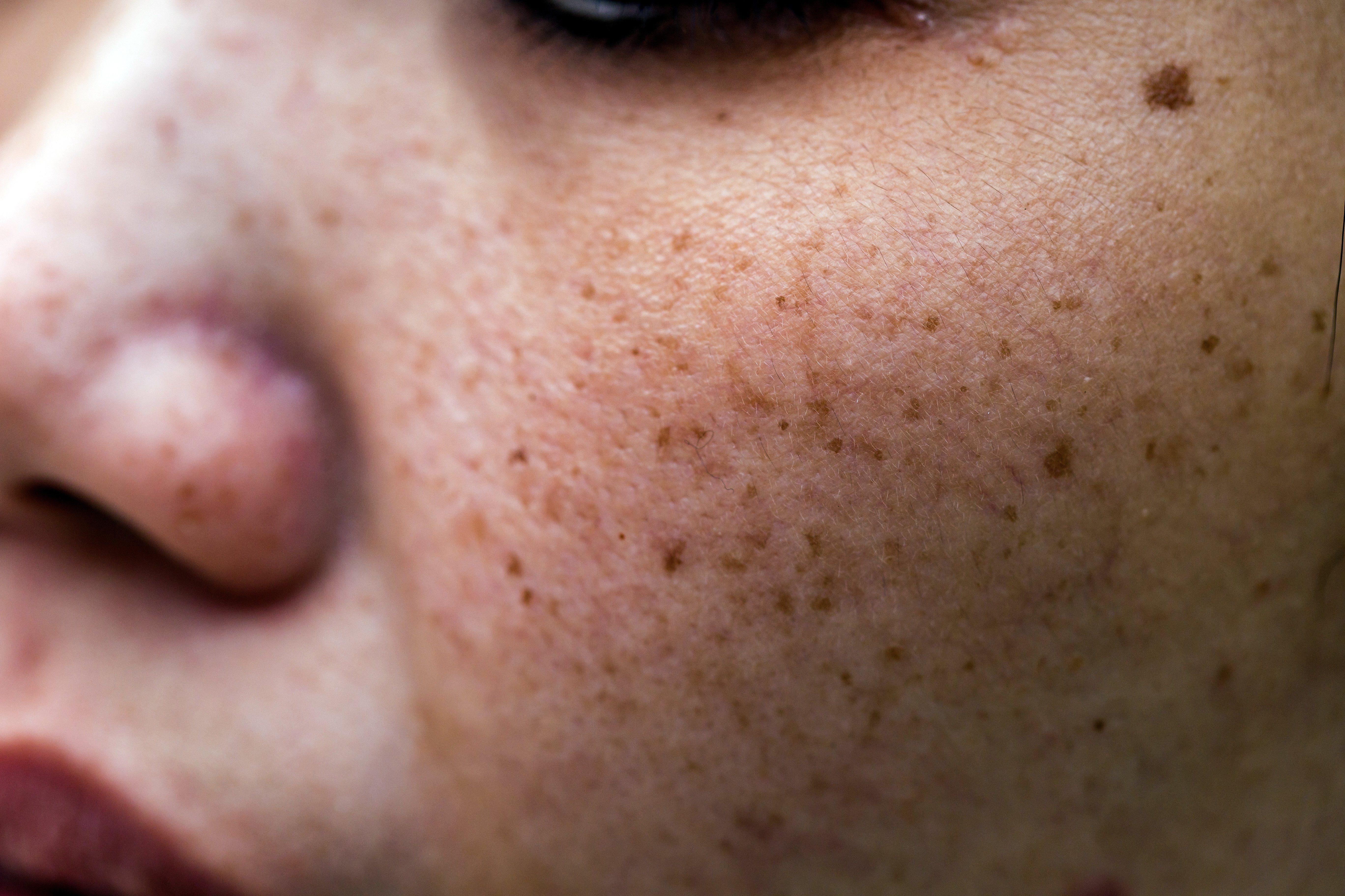 HYPERPIGMENTATION