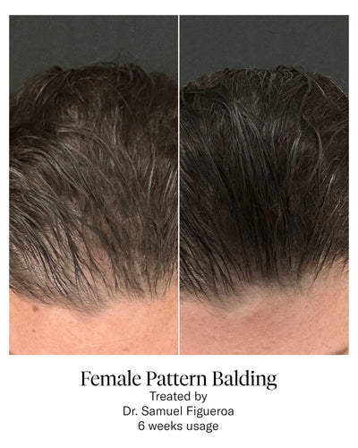 ADVANCED HAIR SYSTEM | Hair loss | LOSHEN & CREM