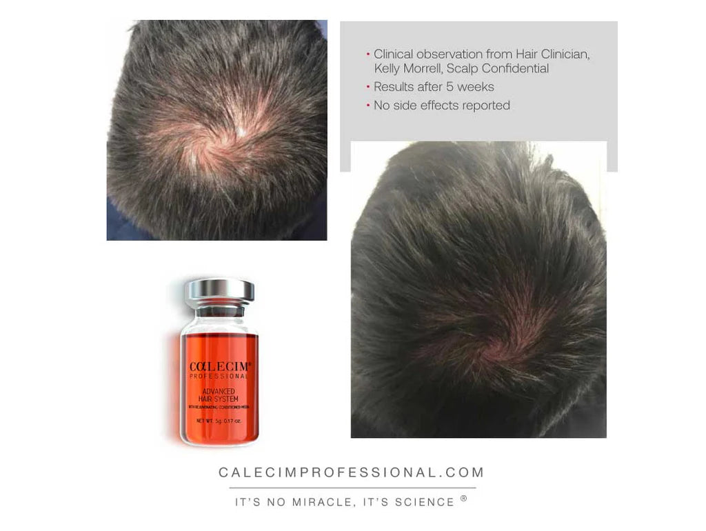 ADVANCED HAIR SYSTEM | Hair loss | LOSHEN & CREM