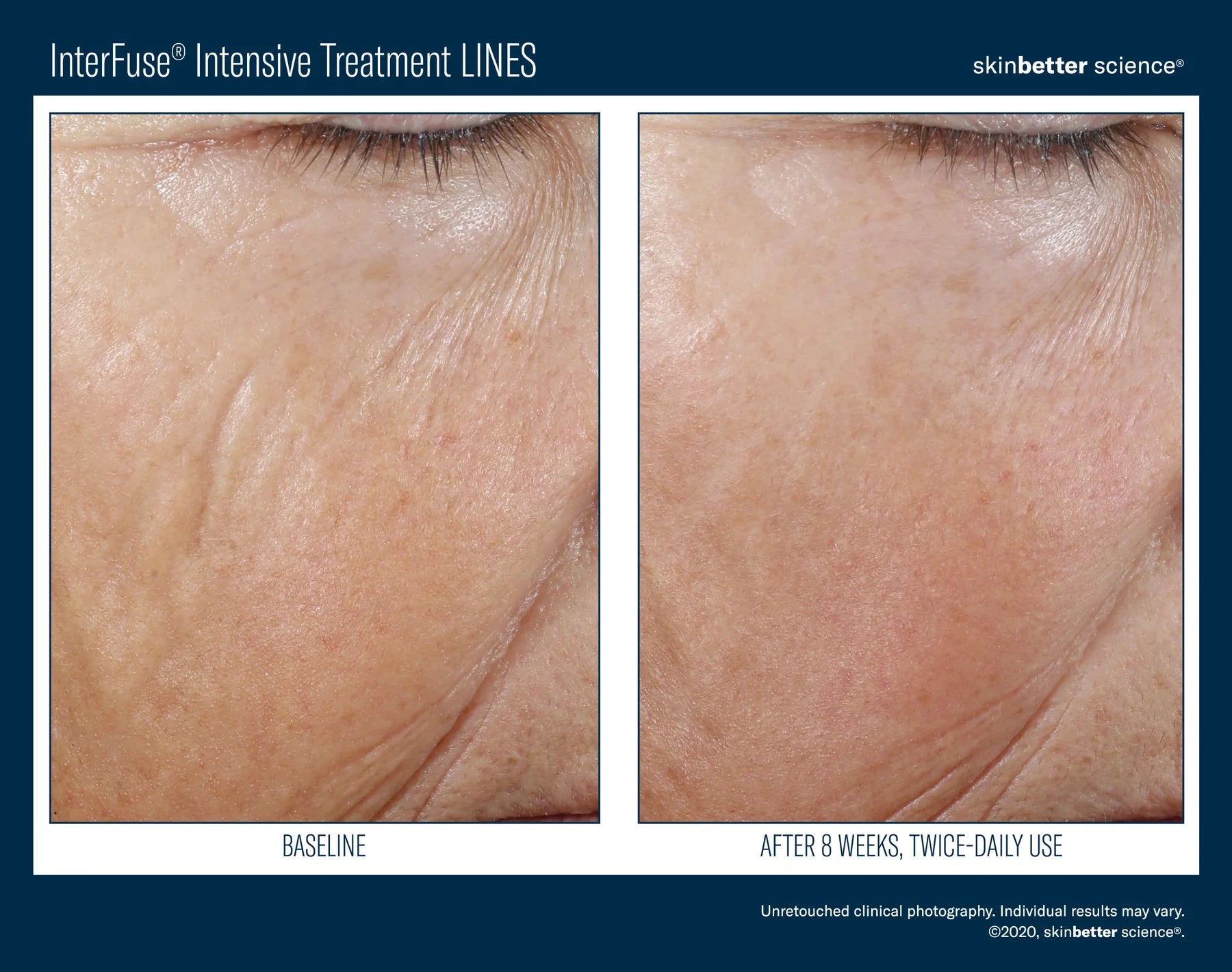 INTERFUSE INTENSIVE TREATMENT CREAM LINES | Healthy aging cream | LOSHEN & CREM